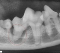 Tooth root abscess